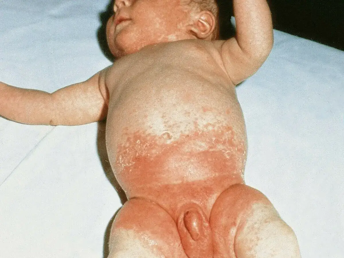Baby mit rotem Hautausschlag, m&ouml;glicherweise ein Hautpilz am Po.
