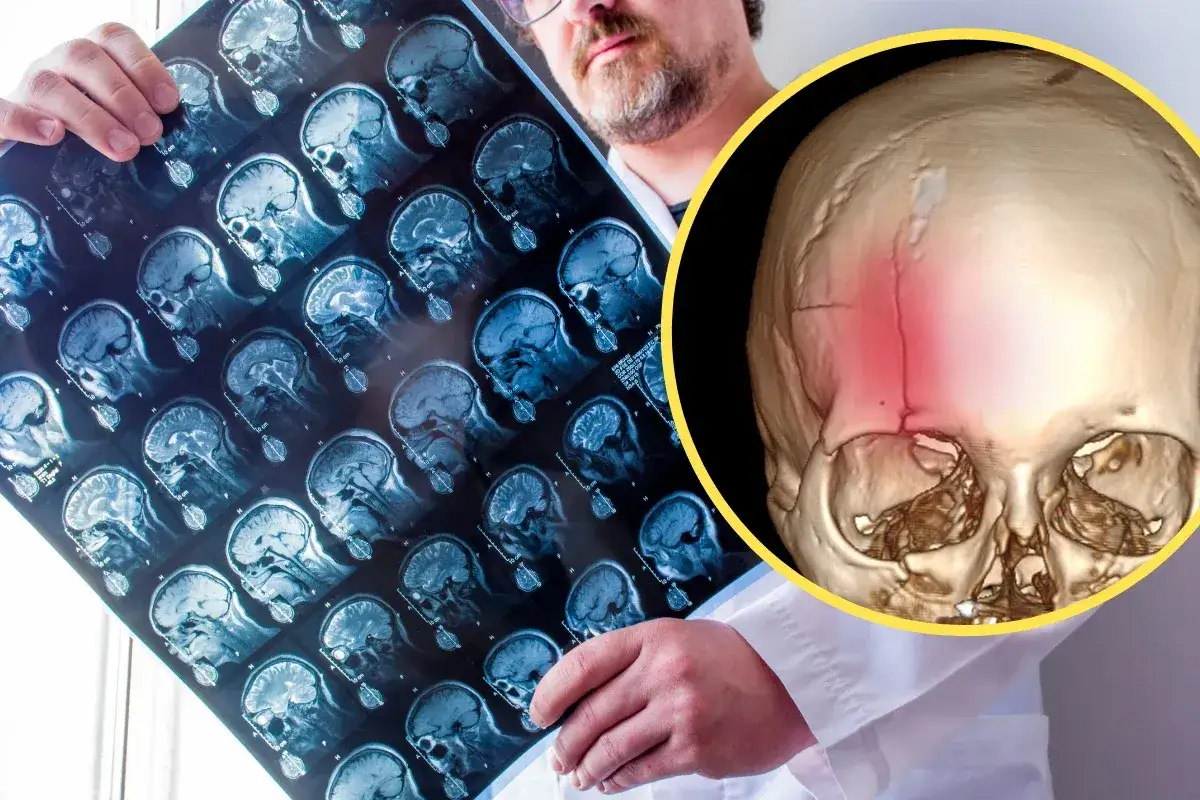 Lekarz analizuje rezonans magnetyczny, szukając oznak krwiaka w głowie. Obok widok czaszki z zaznaczonym urazem.