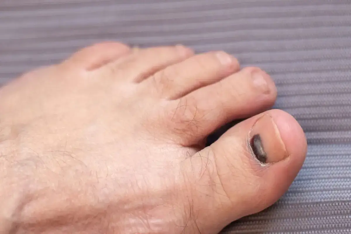 Gros plan sur un pied masculin, montrant un ongle bleu foncé sur l'orteil.