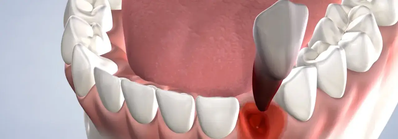 Vista detallada de una boca con un diente a punto de ser extraído, mostrando la encía inflamada y el hueco donde se realizará la exodoncia dental.
