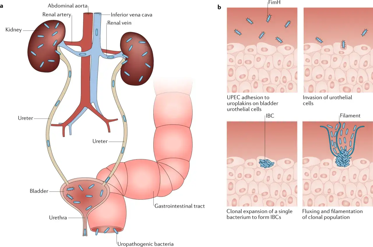 Schéma du système urinaire et des étapes d'une infection urinaire causée par un germe. Les bactéries envahissent la vessie et les reins.