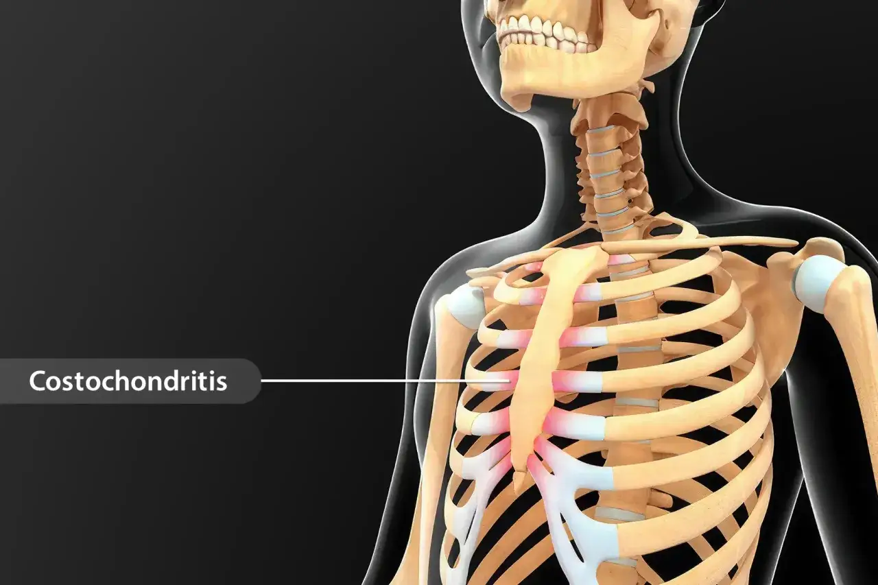Anatomia klatki piersiowej z zaznaczonym zapaleniem chrząstek żebrowych, które może powodować neuralgia międzyżebrowa.
