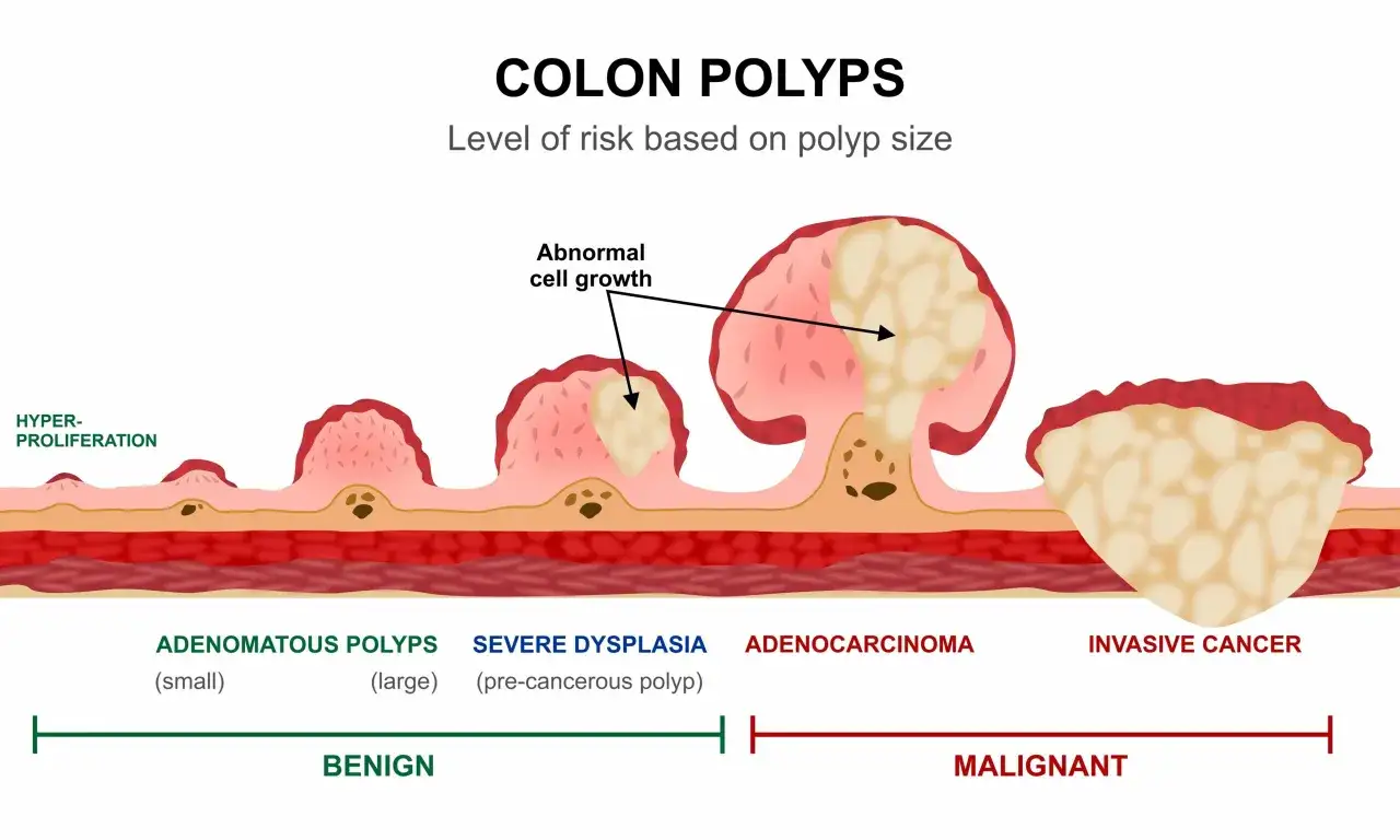 Illustrazione mostra polipi del colon, da benigni a maligni, con crescita cellulare anomala. Alcuni polipi feci fibrose.