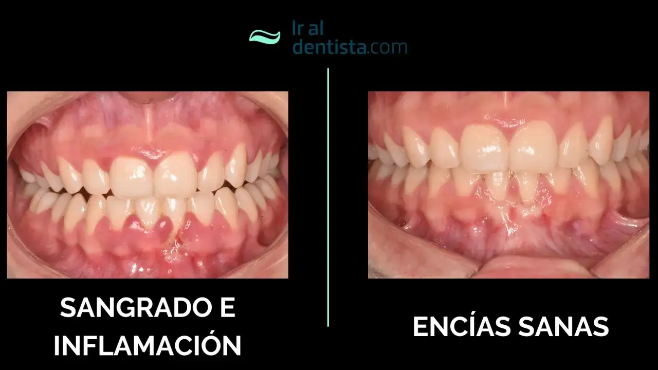 Comparación de encías: antes con sangrado e inflamación, después de una limpieza profunda de encías, mostrando encías sanas.