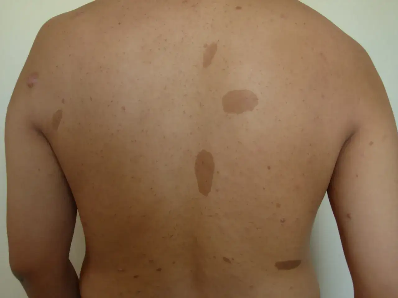 Schiena con macchie caff&egrave; latte, tipiche della neurofibromatosi, e piccoli noduli cutanei.