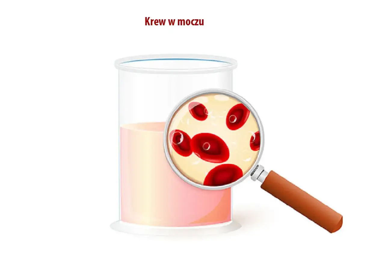 Szklanka z płynem i szkło powiększające ukazujące czerwone krwinki. Tytuł: Krew w moczu.
