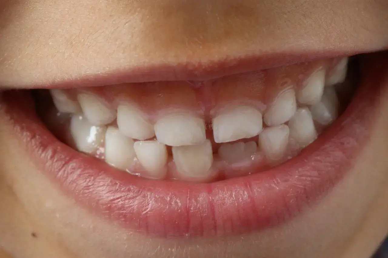 Sorriso di bambino con denti che mostrano segni di ipomineralizzazione, con aree opache e irregolarità.