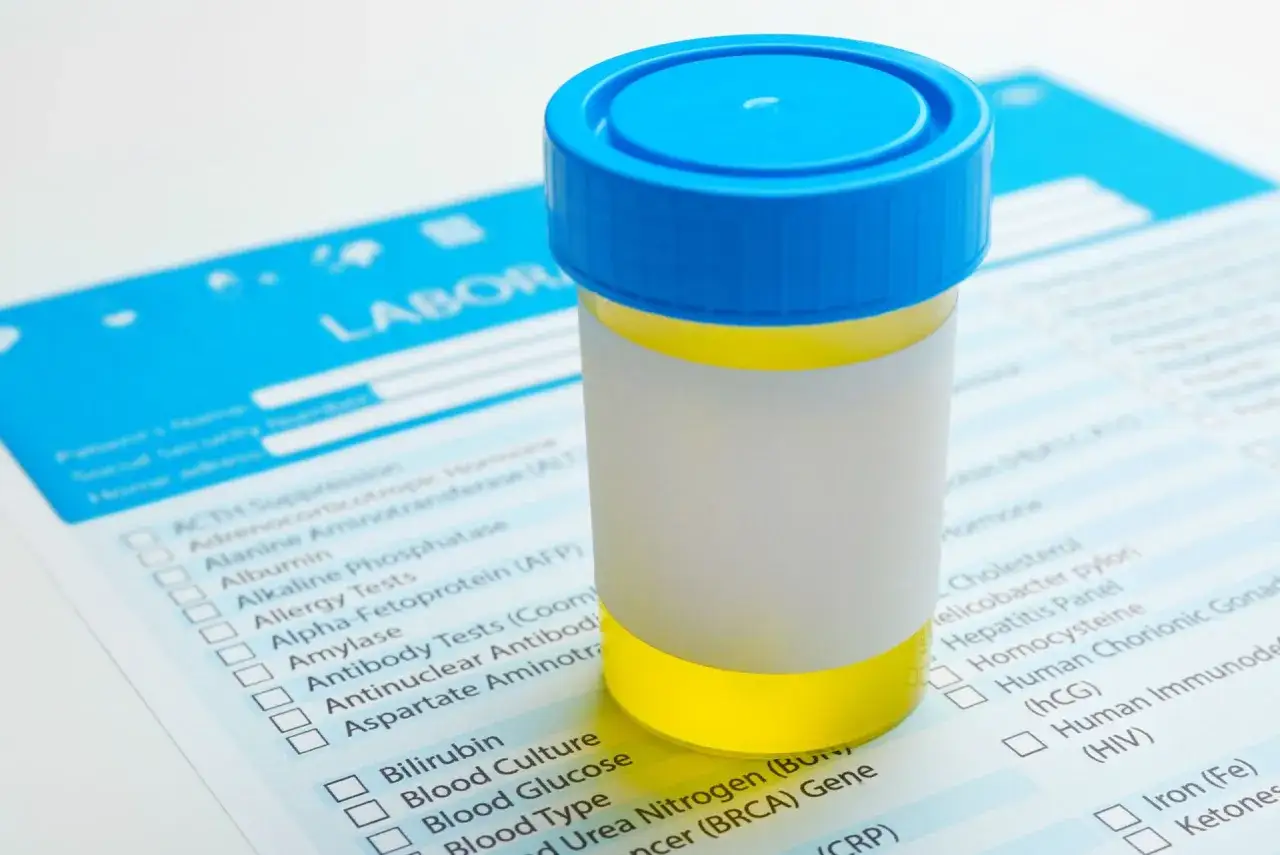 Pojemnik z żółtym moczem na tle formularza laboratoryjnego. Wyniki wskazują, że ciężar właściwy moczu za wysoki.