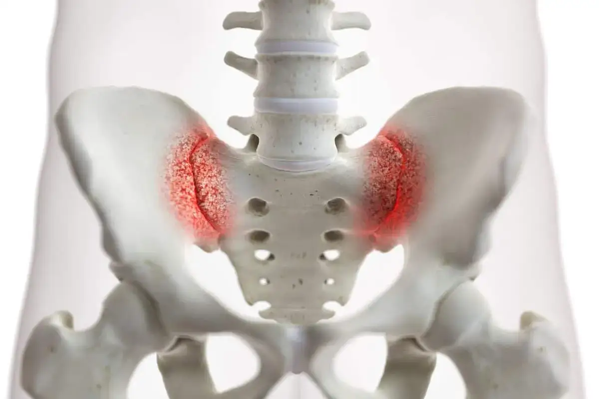 Beckenknochen mit roten Entzündungsanzeichen im ISG-Bereich, relevant für ISG Osteopathie.