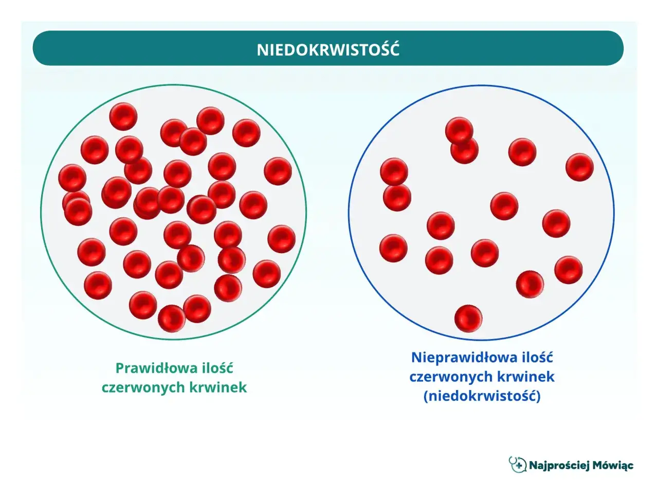 Porównanie liczby czerwonych krwinek: po lewej prawidłowa ilość, po prawej nieprawidłowa (niedokrwistość). WBC morfologia co to jest.