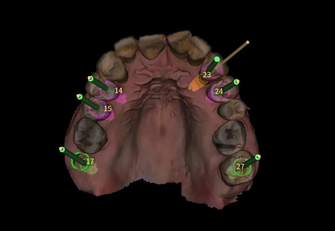 Planowanie implantów zębów: cyfrowa tomografia szczęki z zaznaczonymi punktami 14, 15, 17, 23, 24, 27. Sprawdź tomografia zębów cena.