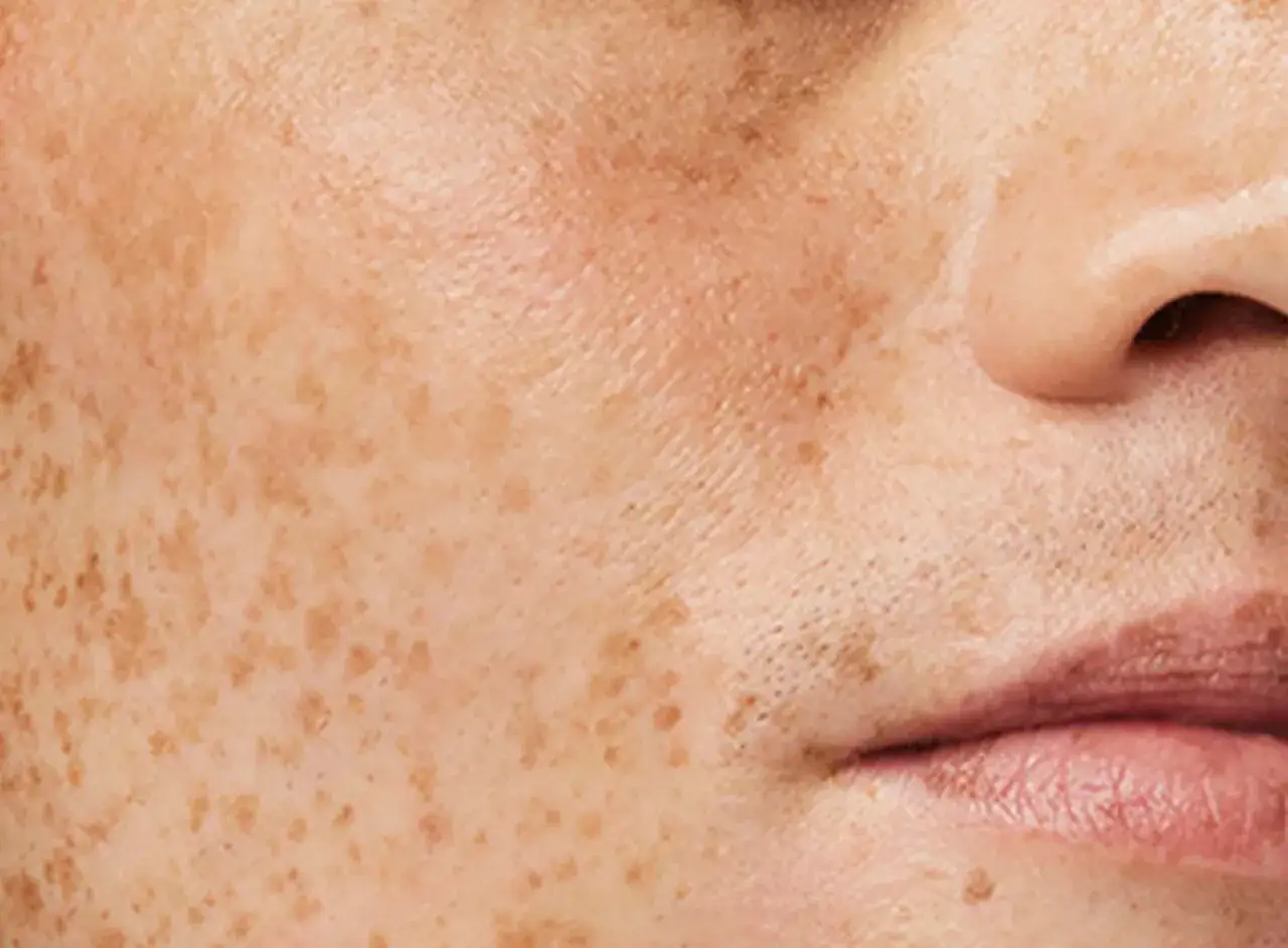 Gros plan sur une peau tachetée, montrant des marques pigmentaires. Une bonne raison pour savoir pourquoi exfolier sa peau.