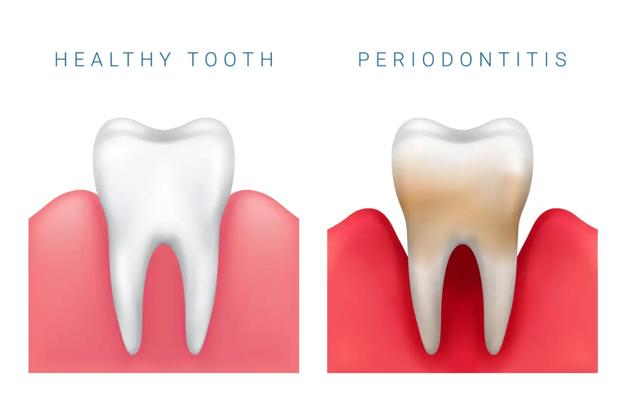 Confronto tra un dente sano e uno affetto da paradontosi dentale, con gengive rosse e infiammate.