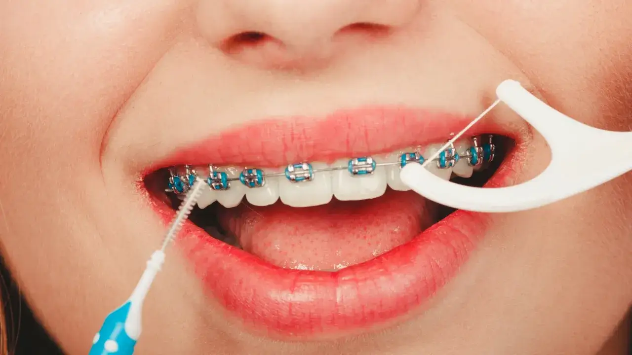 Uśmiech z aparatem ortodontycznym, pokazujący, czym czyścić aparat ortodontyczny: nicią dentystyczną i szczoteczką międzyzębową.