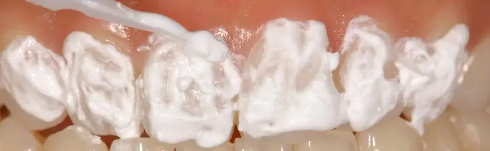 nadwrażliwość zębów po wybielaniu