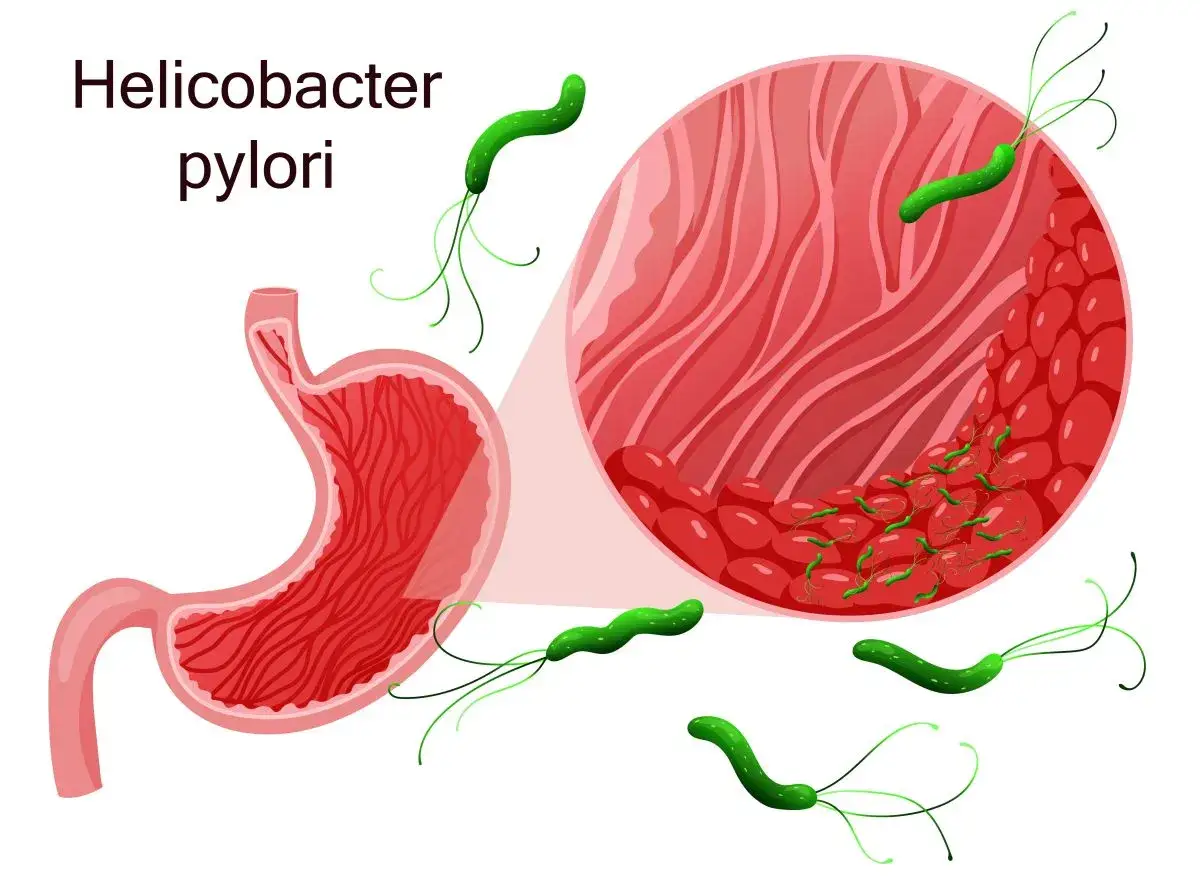 Helicobacter pylori w żołądku. Powiększony obraz pokazuje bakterie na błonie śluzowej. Objawy mogą być różne.