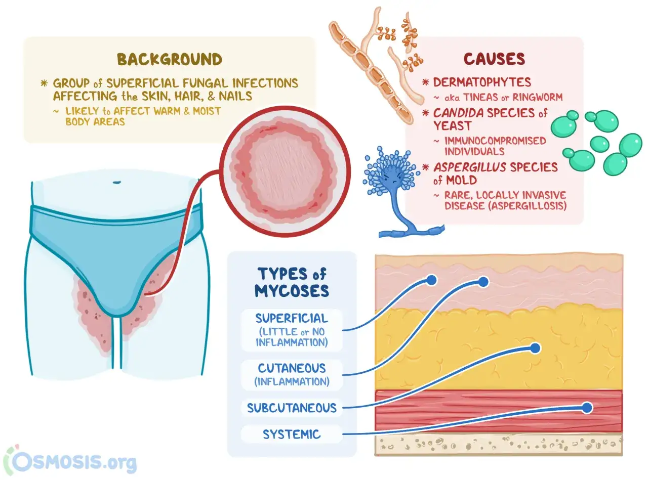Ilustración explica por qué salen hongos en la piel: infecciones fúngicas superficiales causadas por dermatofitos, levaduras o moho, que prosperan en zonas cálidas y húmedas.