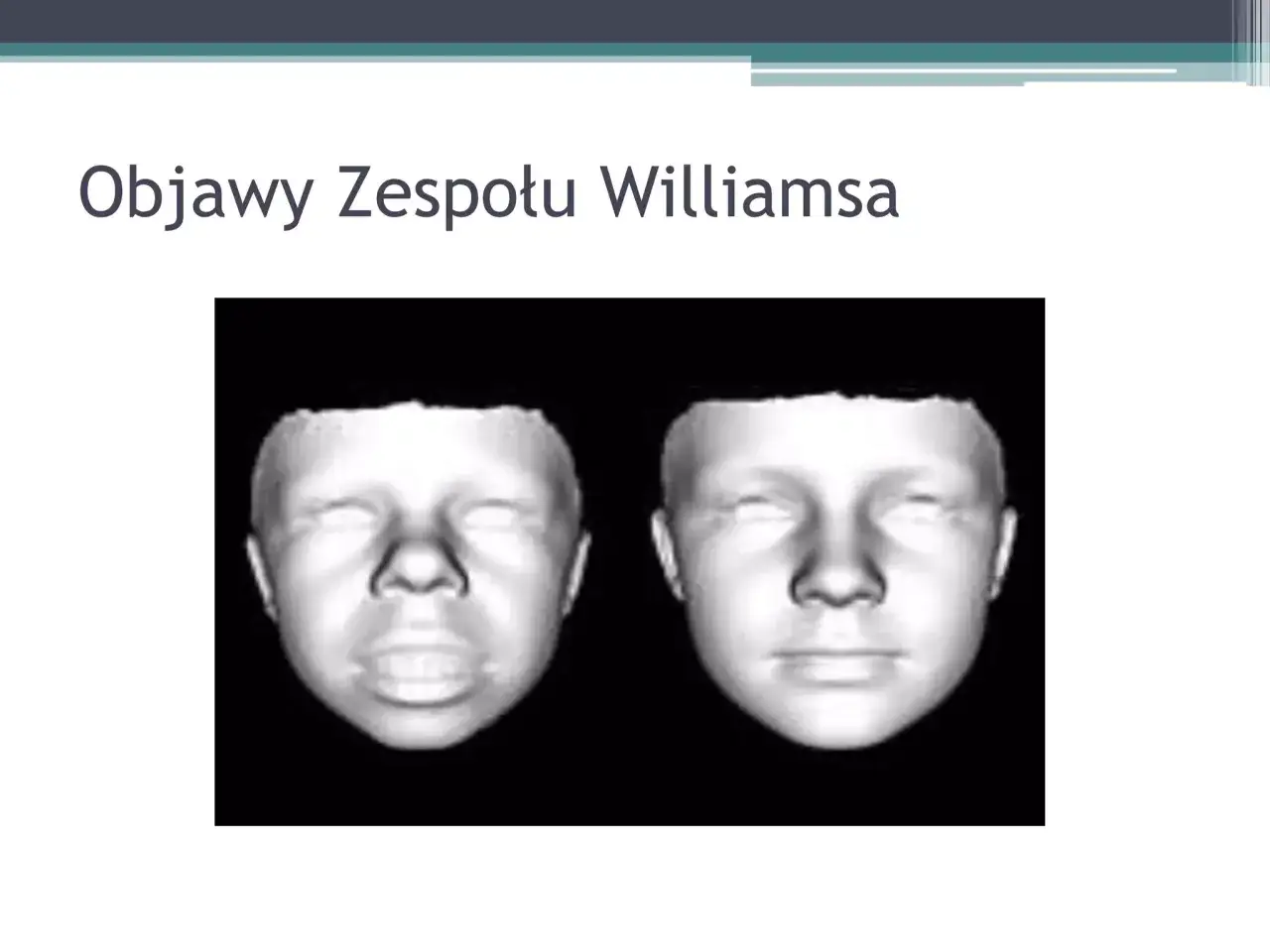 Dwa skany twarzy dzieci. Lewa twarz ma szersze usta i bardziej widoczne zęby, co jest jednym z objawów zespołu Williamsa.