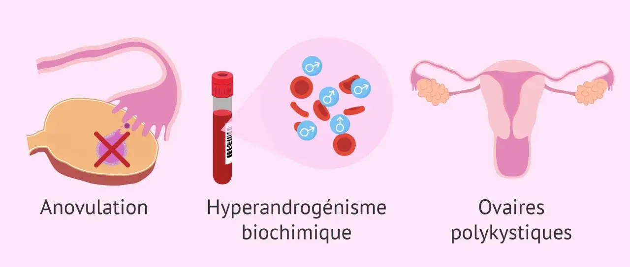 Sch&eacute;ma illustrant les trois crit&egrave;res du diagnostic SOPK : anovulation, hyperandrog&eacute;nisme biochimique et ovaires polykystiques.