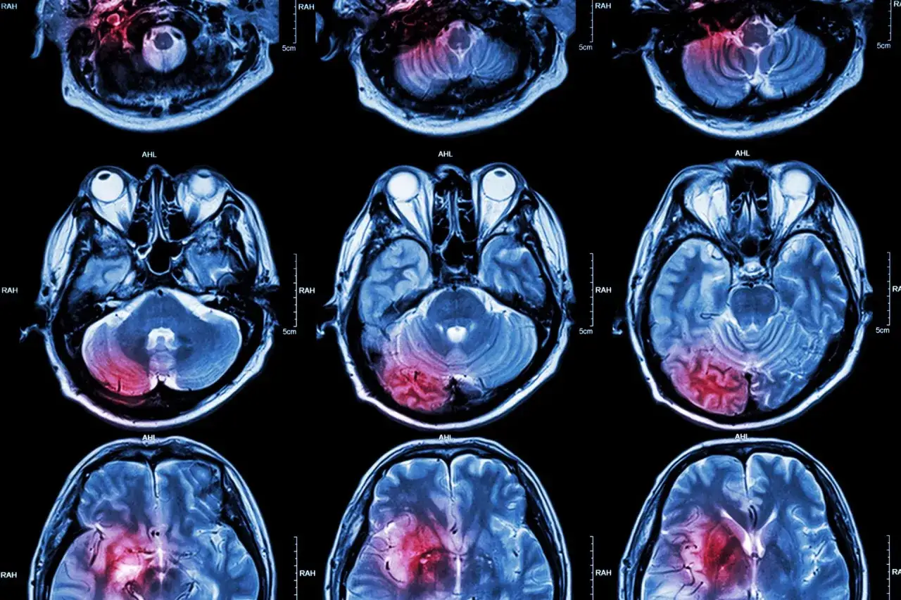 Przekroje mózgu pokazujące obszar apopleksji, zaznaczony na czerwono. Widoczne uszkodzenia w różnych płaszczyznach.