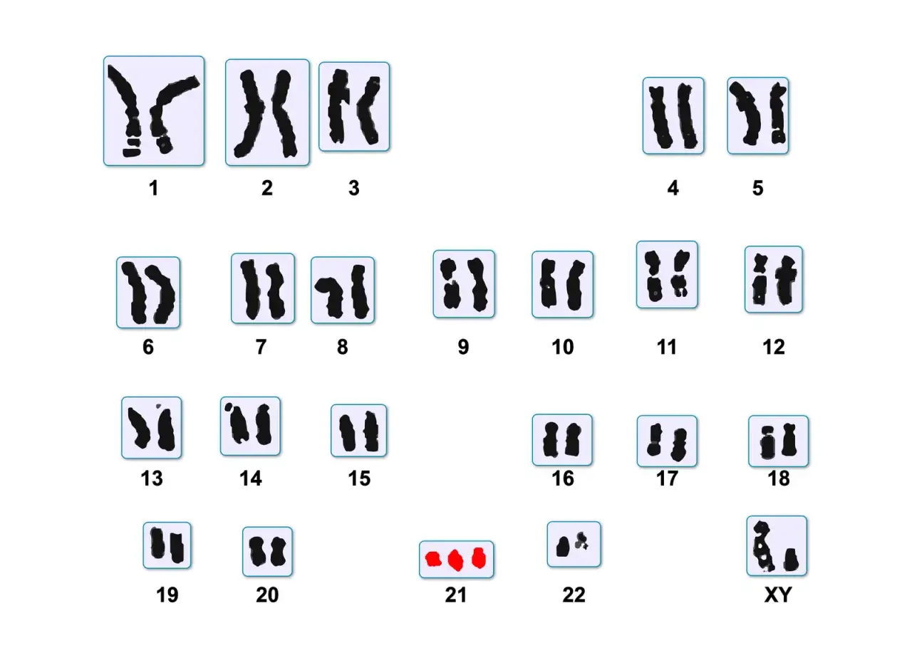 Kariotyp przedstawia trisomię chromosomu 21, charakterystyczną dla zespołu Pradera-Williego.