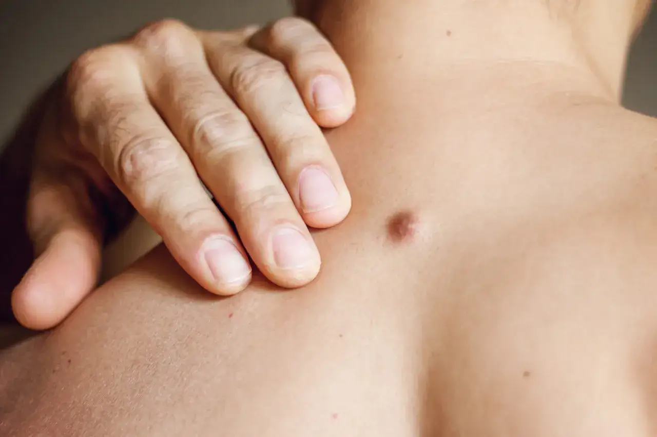 Mano che sfiora una piccola protuberanza pelle sulla spalla, evidenziando la texture cutanea.