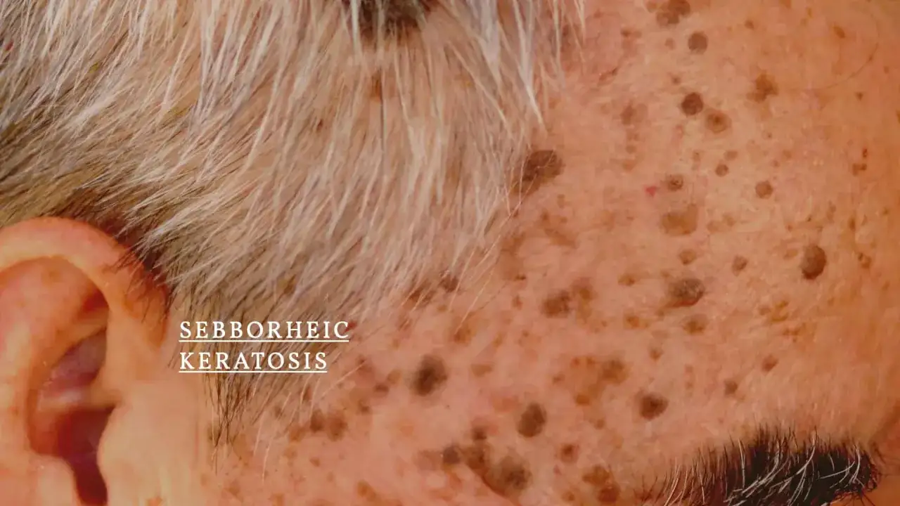 Gros plan sur le visage d'une personne &acirc;g&eacute;e montrant des k&eacute;ratoses s&eacute;borrh&eacute;iques. Recherche d'un traitement naturel pour ces l&eacute;sions cutan&eacute;es.