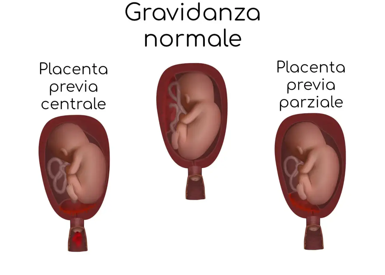 Illustrazione di gravidanze con placenta bassa: centrale, parziale e normale. La placenta bassa centrale copre interamente l'utero.