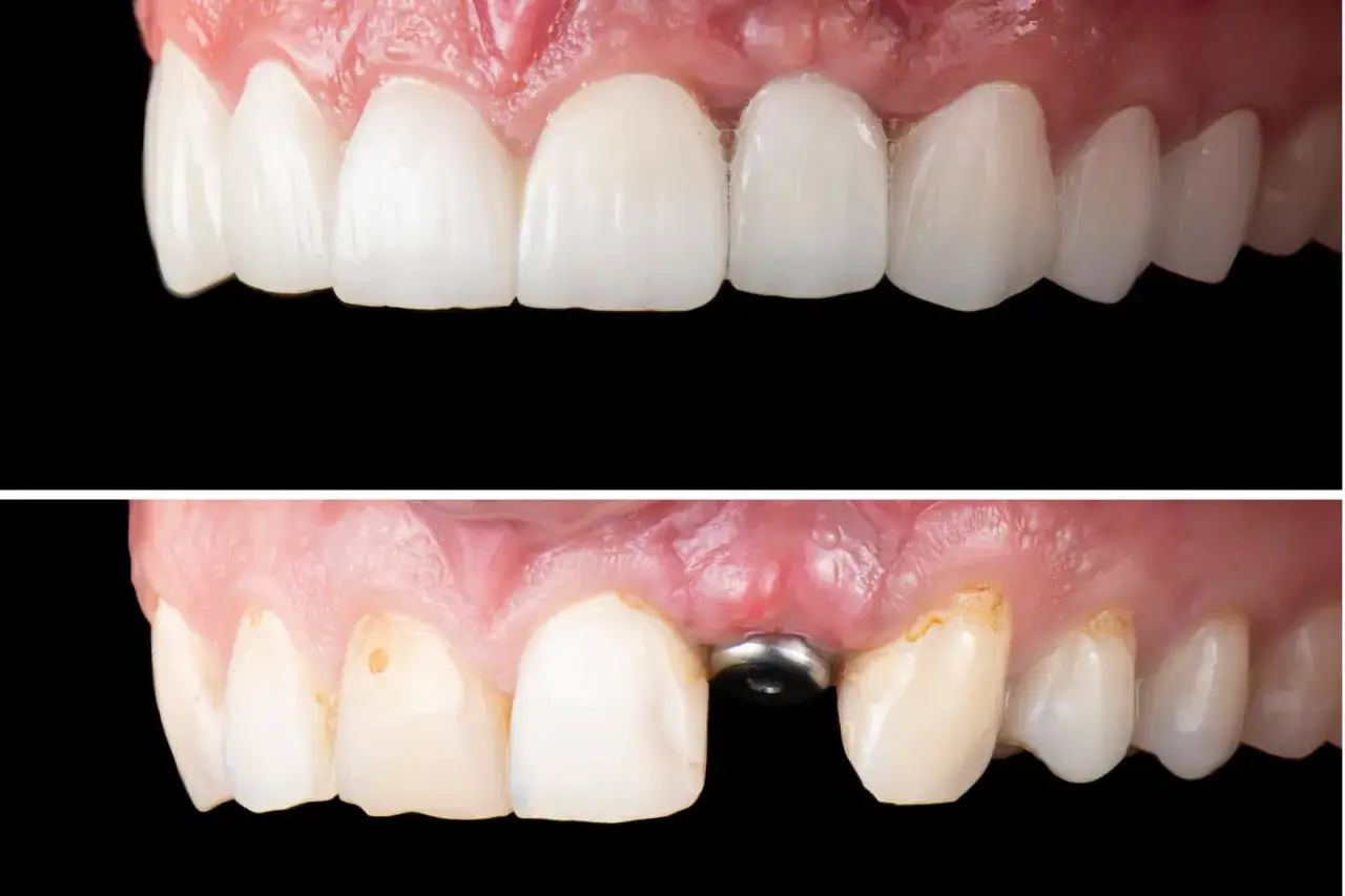 Przed i po: zdrowe zęby vs. implant zębowy. Sprawdź, jaka jest tureckie zęby cena i odzyskaj piękny uśmiech!