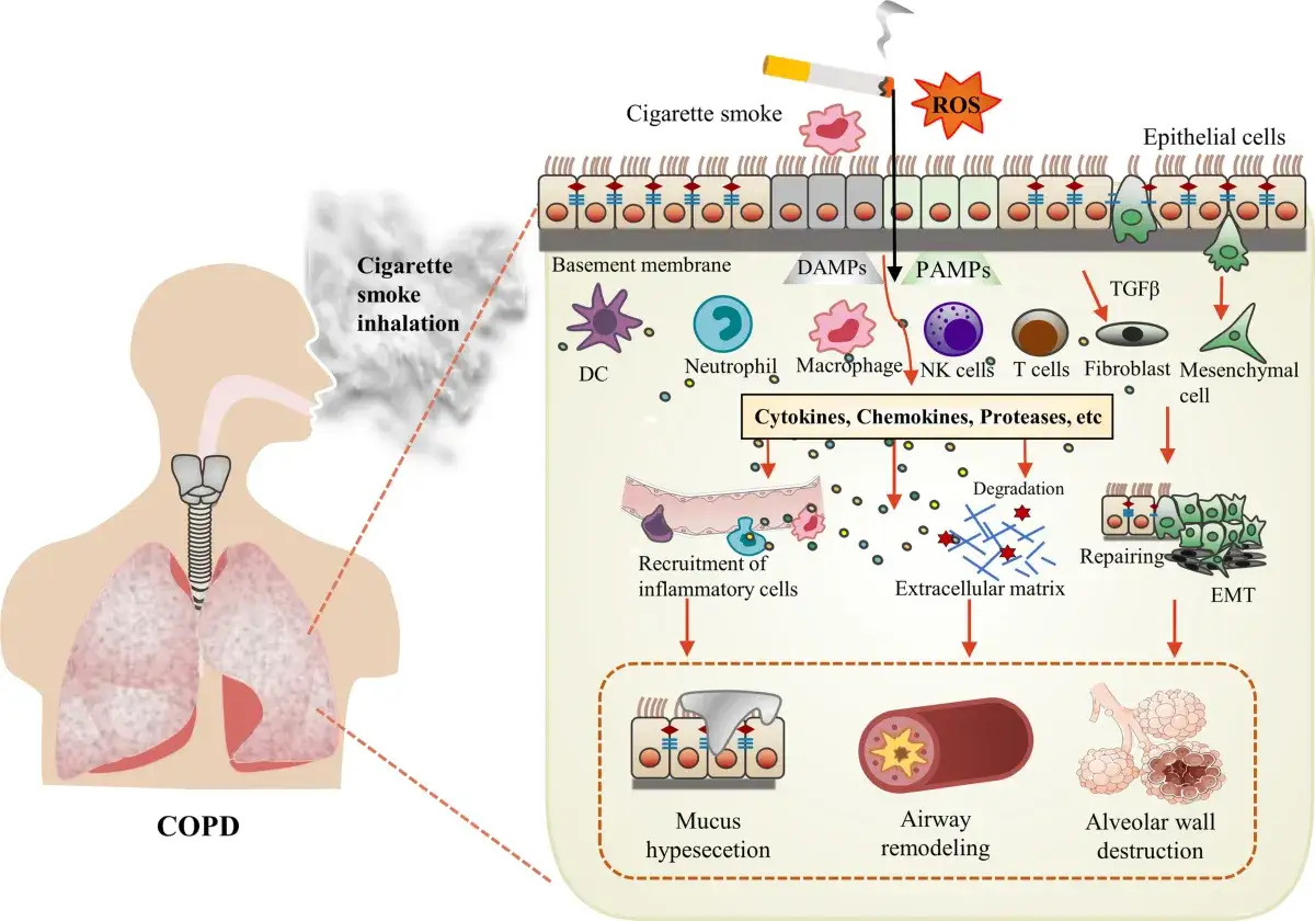 Schema zeigt, wie Zigarettenrauch COPD verschlimmert: Entz&uuml;ndungen, Schleim, Umbau der Atemwege und Zerst&ouml;rung der Lungenbl&auml;schen.
