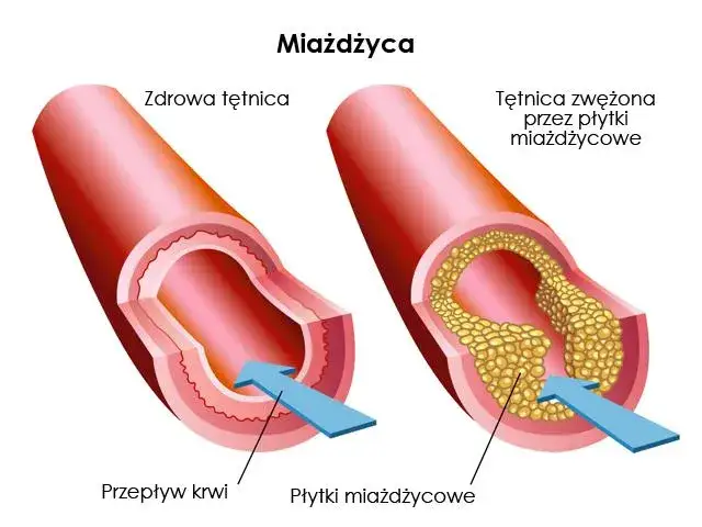 schemat budowy cholesterolu w organizmie lub naczynia krwionośne z blaszką miażdżycową