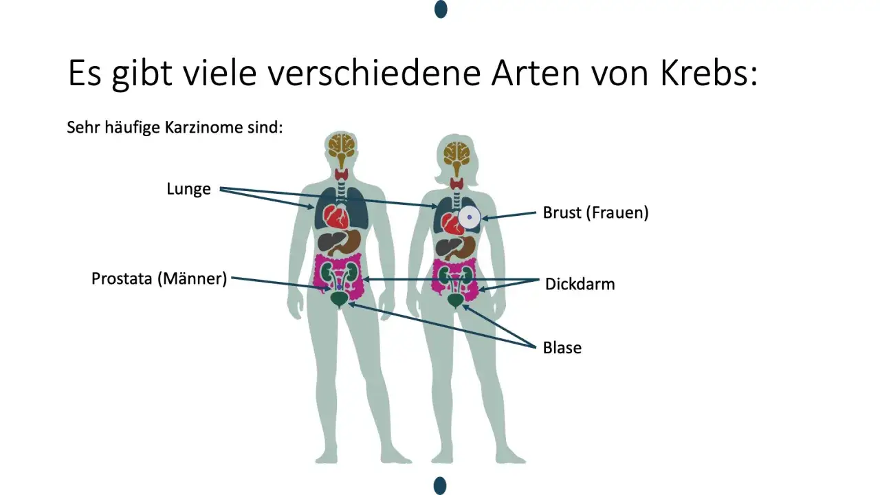 Abbildung zeigt, welche Krebsarten es gibt: Lunge, Prostata, Brust, Dickdarm und Blase sind häufige Karzinome.