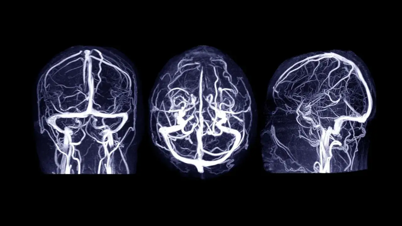 Gehirn Aneurysma oder Bluthochdruck