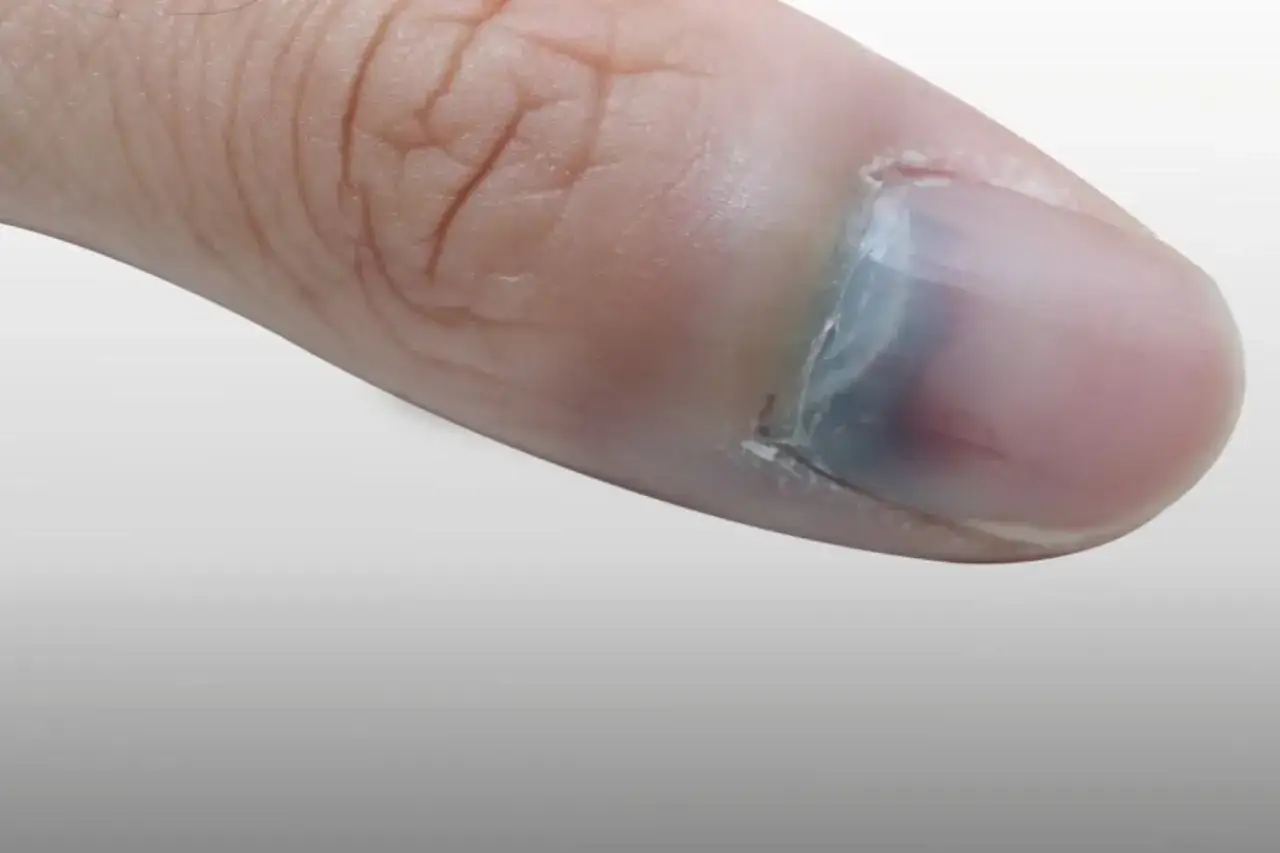 Gros plan d'un pouce avec une ampoule sous l'ongle, visible par la coloration bleu-noir sous l'ongle.