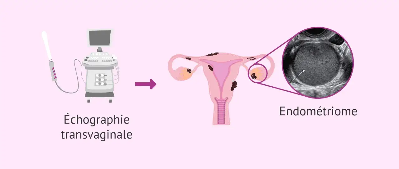&Eacute;chographie transvaginale montrant un ut&eacute;rus avec des l&eacute;sions d'endom&eacute;triose, dont un endom&eacute;triome. L'endom&eacute;triose peut affecter la grossesse.