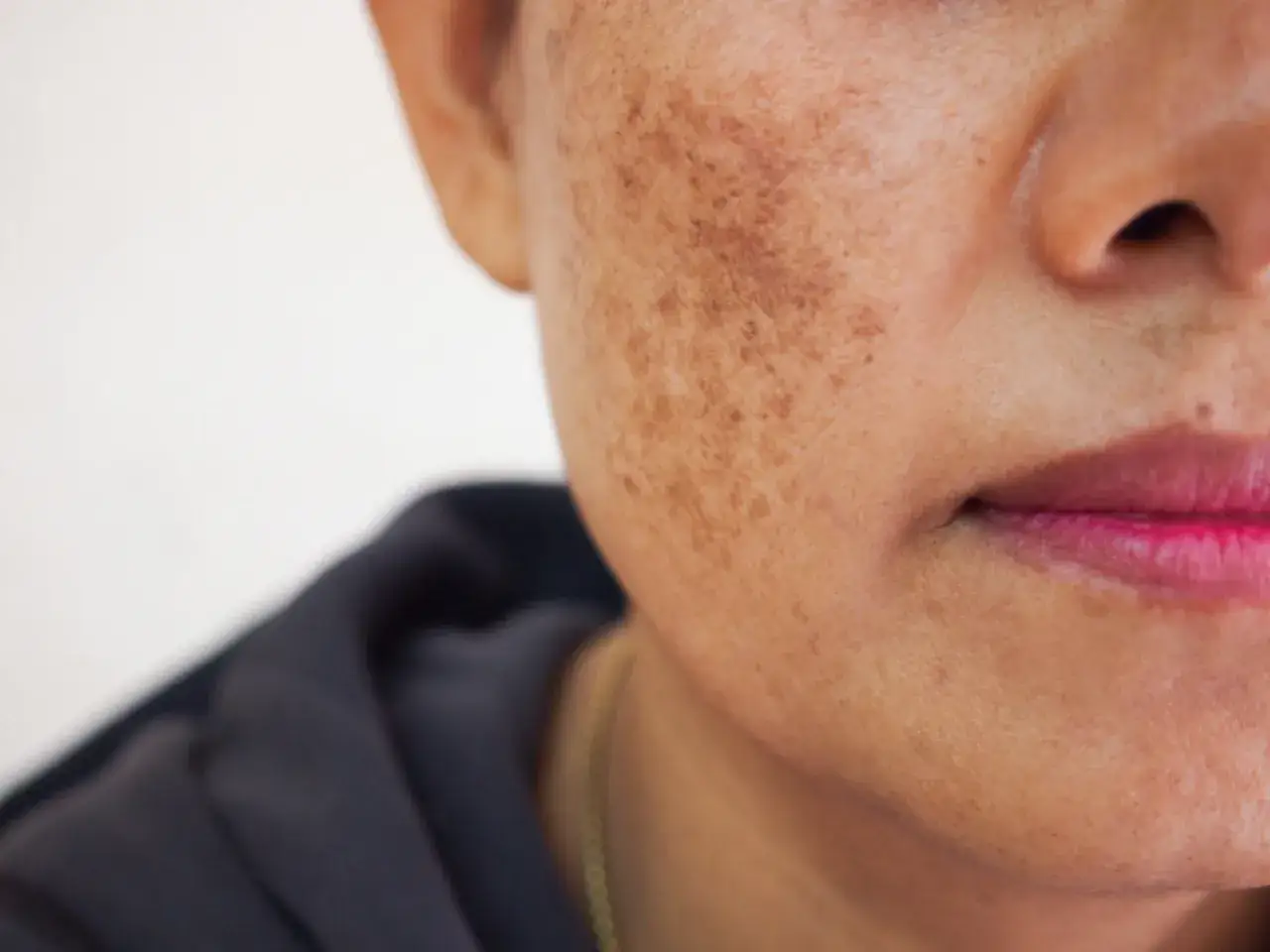 Nahaufnahme eines Gesichts mit Melasma-Flecken auf der Wange. Die Haut zeigt ungleichmäßige Pigmentierung, die auf Melasma hindeutet.