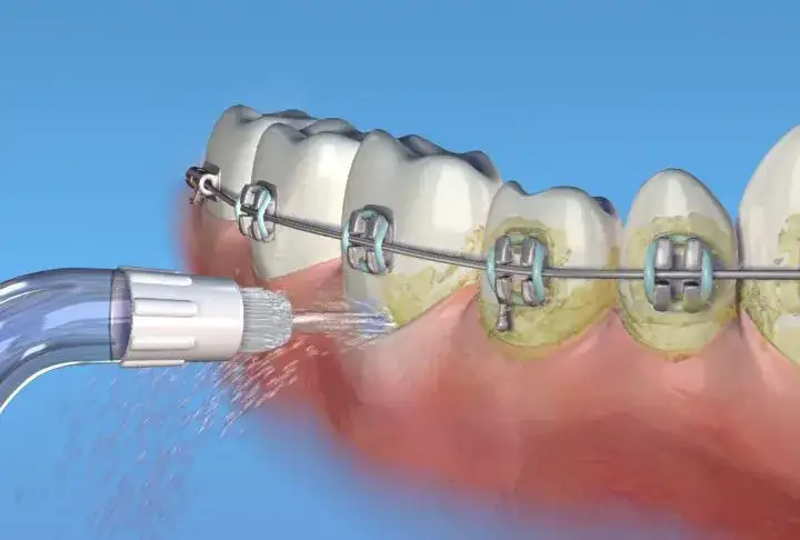 irygator do aparatu ortodontycznego implantów wrażliwych dziąseł