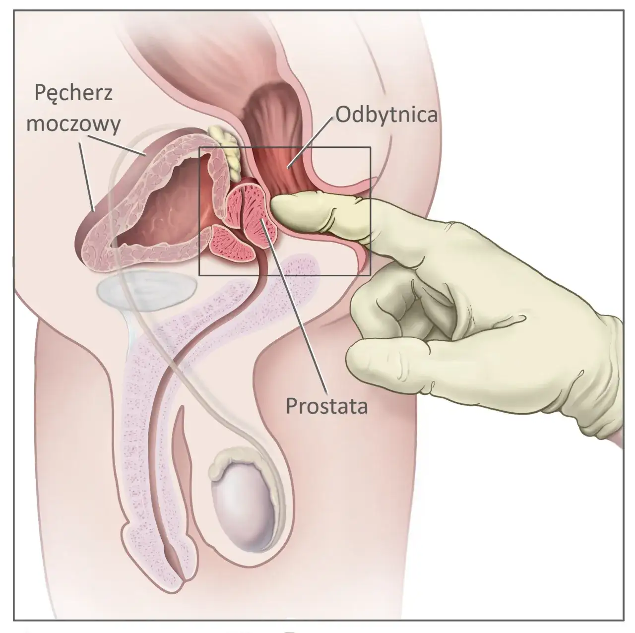 schemat badania per rectum prostaty