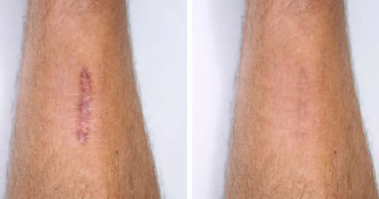 Widoczne blizny po trądziku laserowo wygładzone. Skóra po zabiegu wygląda znacznie lepiej.