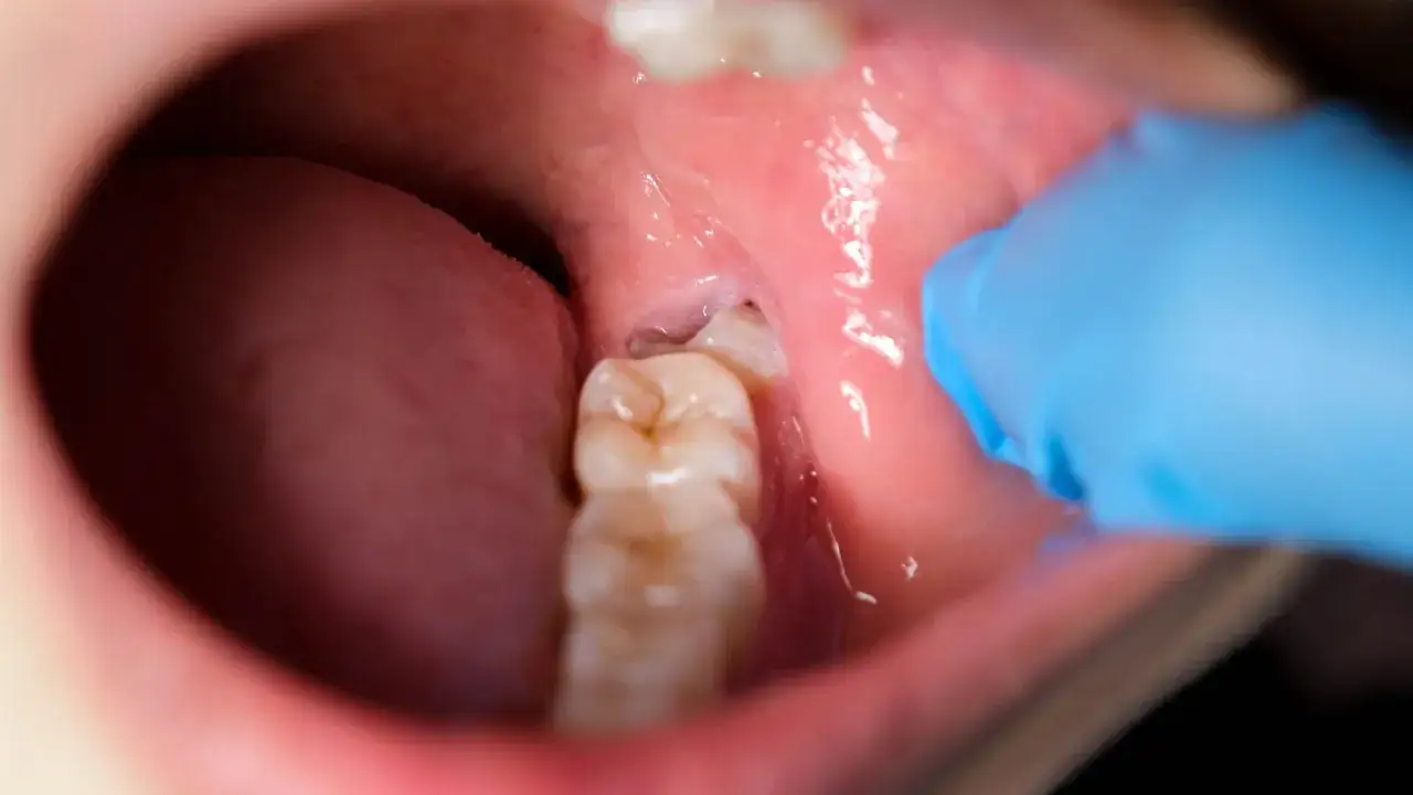 Gloved finger points to a tooth with visible inflamacion encia muela.