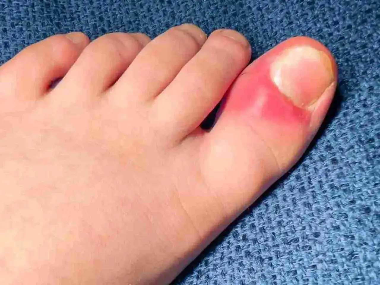 Dito si vede un alluce infiammato, rosso e gonfio. Potrebbe essere utile cercare rimedi per alleviare il dolore e l'infiammazione.