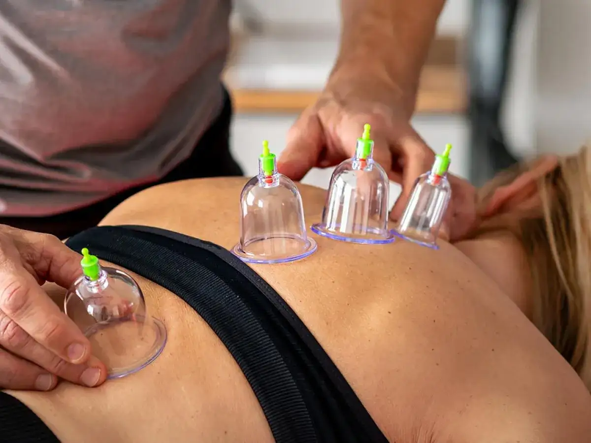 Masaż bańką chińską: cztery bańki na plecach pacjentki, terapeuta przygotowuje się do zabiegu.