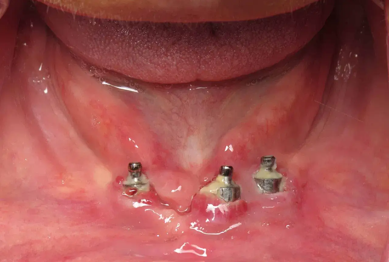 Zapalenie dziąseł wok&oacute;ł implant&oacute;w, potencjalne skutki uboczne noszenia protez zębowych.