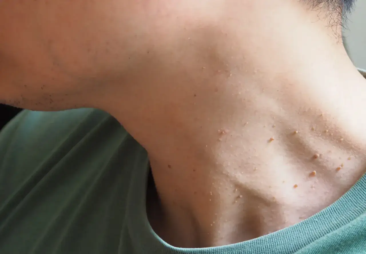 Gros plan sur le cou d'une personne, r&eacute;v&eacute;lant de nombreuses petites excroissances de chair de couleur chair, certaines ressemblant &agrave; de minuscules grains de riz.