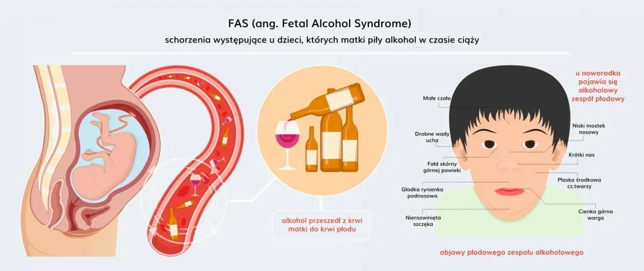 Ilustracja pokazuje płód w łonie matki, alkohol przechodzący do krwiobiegu płodu i objawy FAS u noworodka.