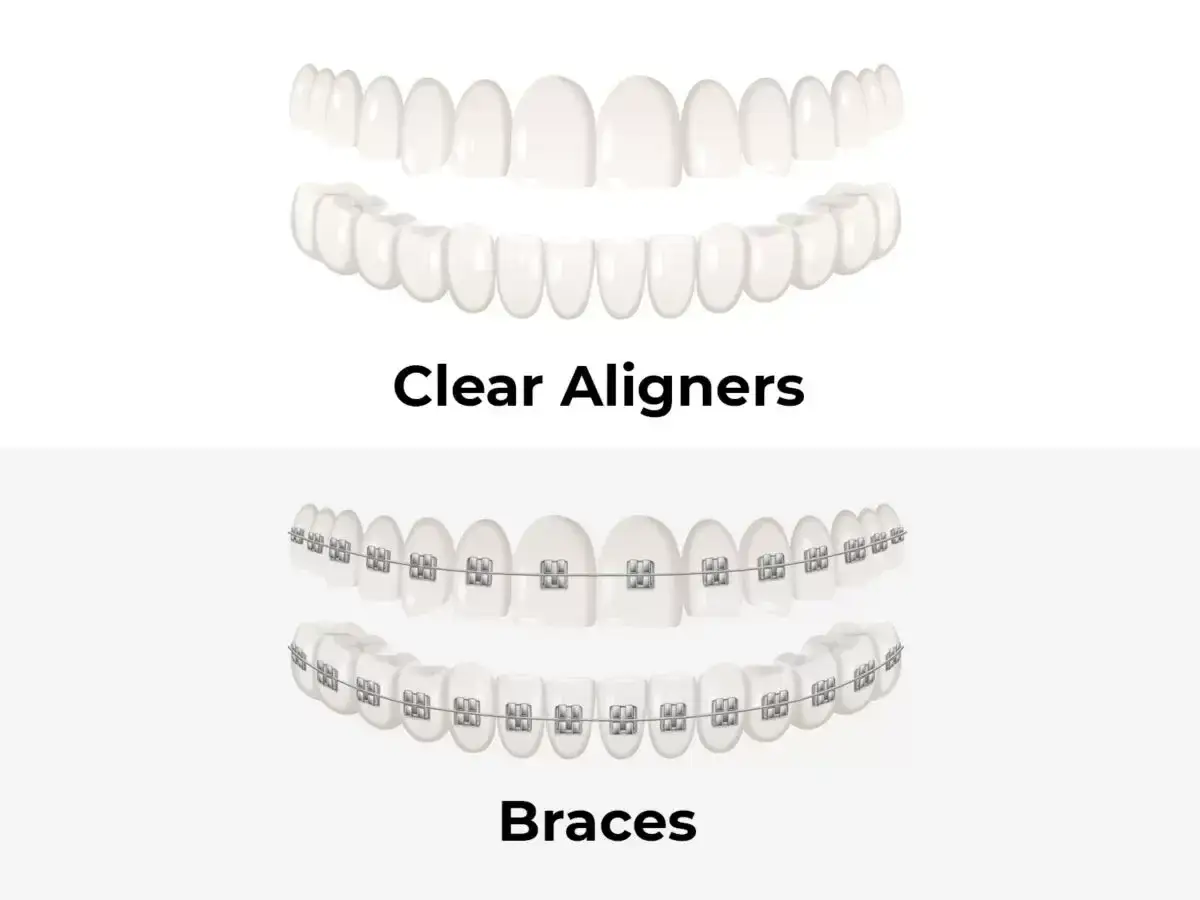 Górny łuk z przezroczystymi nakładkami, dolny z tradycyjnym aparatem ortodontycznym. Wybierz swój aparat invisalign lub tradycyjny.
