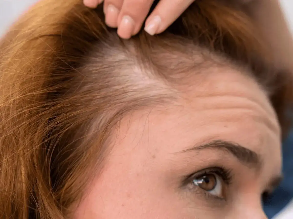 Primer plano del cuero cabelludo y la frente de una mujer, mostrando c&oacute;mo crece el pelo.
