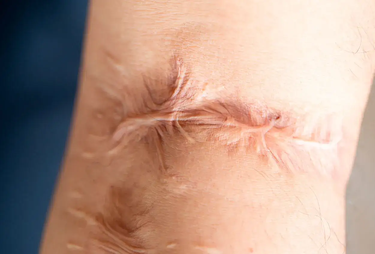 Gros plan sur une cicatrice qui br&ucirc;le, t&eacute;moignant d'une blessure pass&eacute;e. La peau est tendue et marqu&eacute;e.