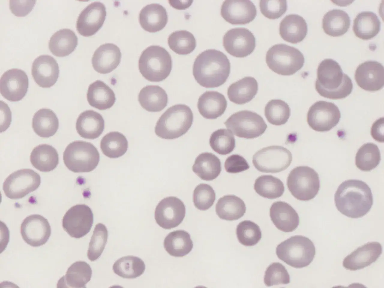 Mikroskopowy obraz krwi z widoczną anizocytozą erytrocytów – krwinki czerwone o różnych kształtach i rozmiarach, niektóre owalne, inne okrągłe.