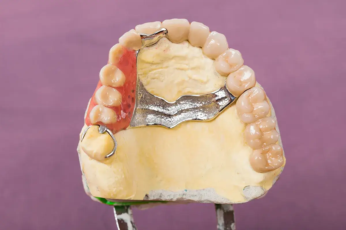 Modello di protesi dentale, un ponte mobile denti con struttura metallica e denti in resina su base in gesso.